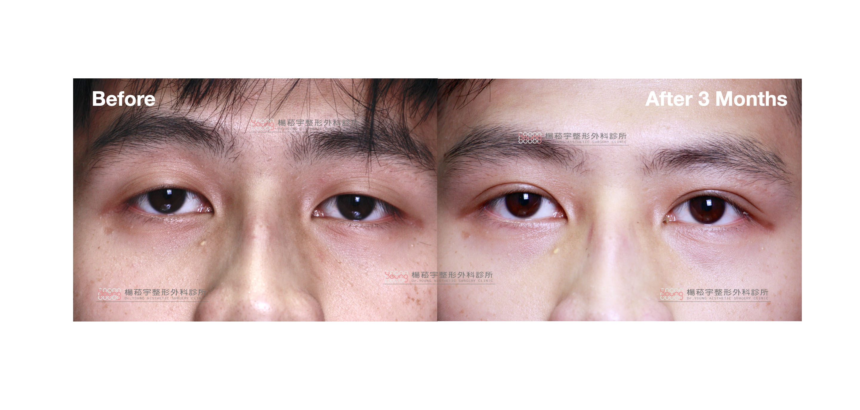 眼部綜合：雙眼皮、提眼肌、提眉