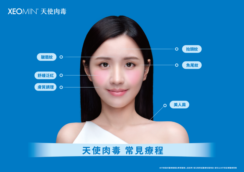 天使肉毒 適合治療項目／部位：可用於治療動態紋路如皺眉紋、抬頭紋、魚尾紋、其他臉部修飾，以及膚質調理(水光肉毒)，與其他身體部位修飾如肩頸、上肢 